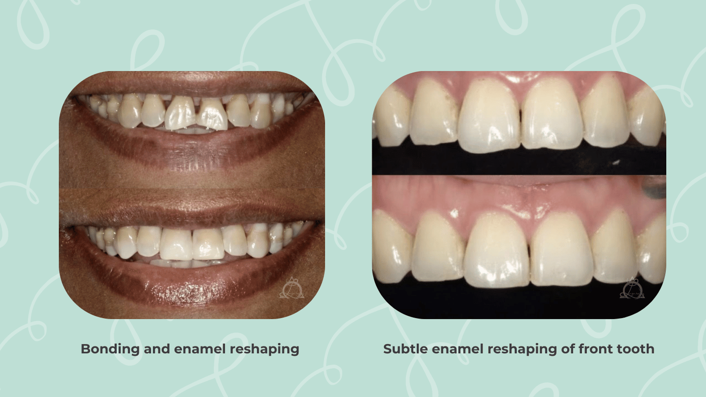 Before and after images of teeth showing the results of bonding and enamel reshaping. The left image highlights significant changes with bonding and reshaping, while the right image shows subtle enamel reshaping of a front tooth.