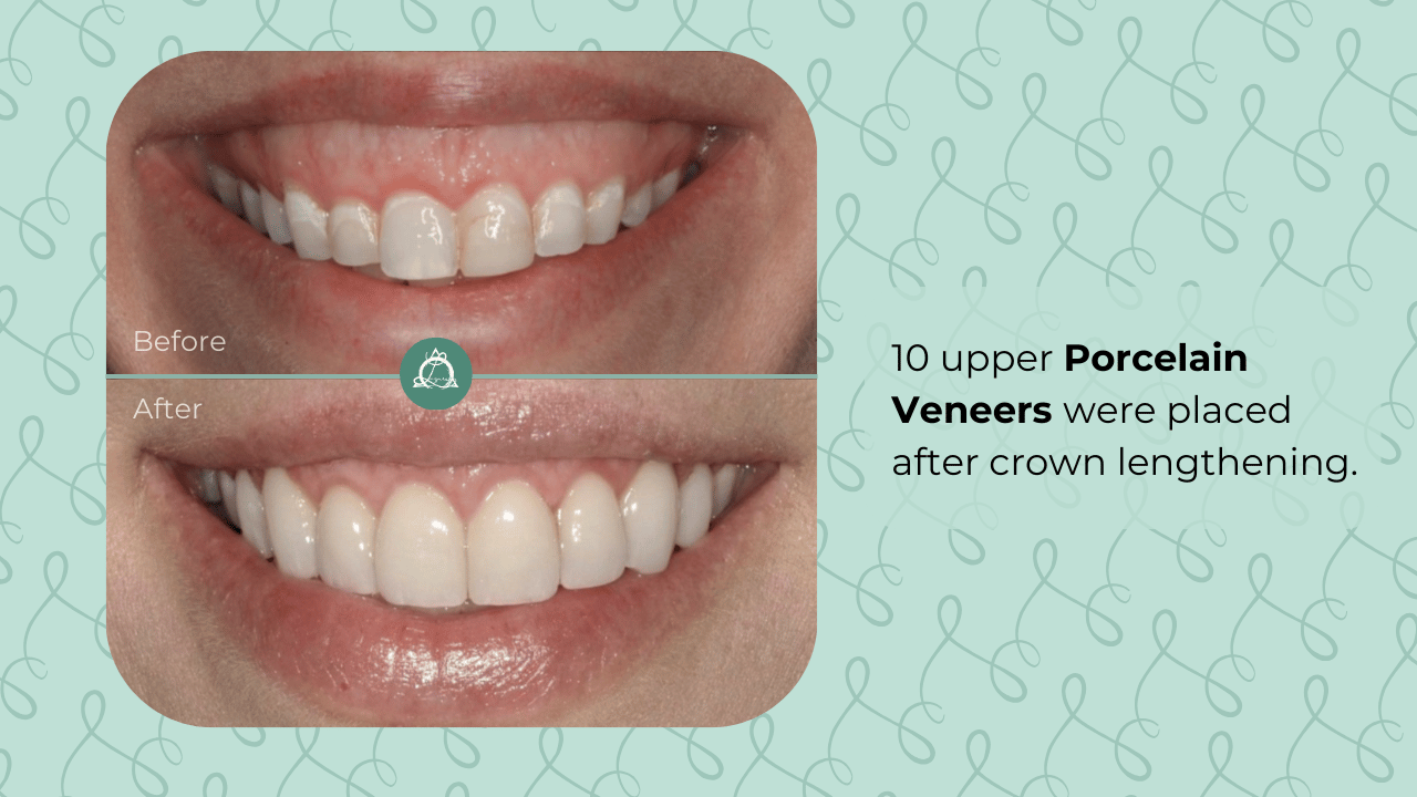 Before and after comparison of a smile with 10 upper Porcelain Veneers placed following crown lengthening, showing a dramatic improvement in tooth appearance and alignment.