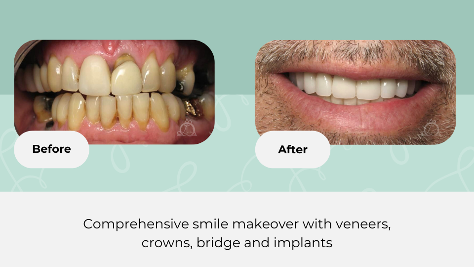 Before and after photos of a patient's comprehensive smile makeover with veneers, crowns, bridge, and implants. The 'Before' image shows discolored and misaligned teeth, while the 'After' image displays a bright, straight smile against a light green background.