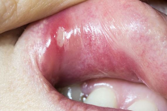 causes of blood blisters in mouth