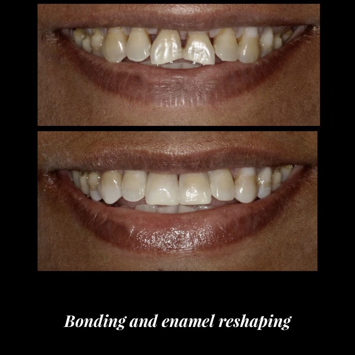 Bonding & Enamel/Gum Reshaping New York Cosmetic Dentist